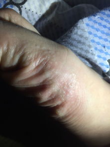 脚上起小水泡还很痒是什么原因(脚上起水泡很痒) 脚上起小水泡还很痒是什么原因(脚上起水泡很痒)